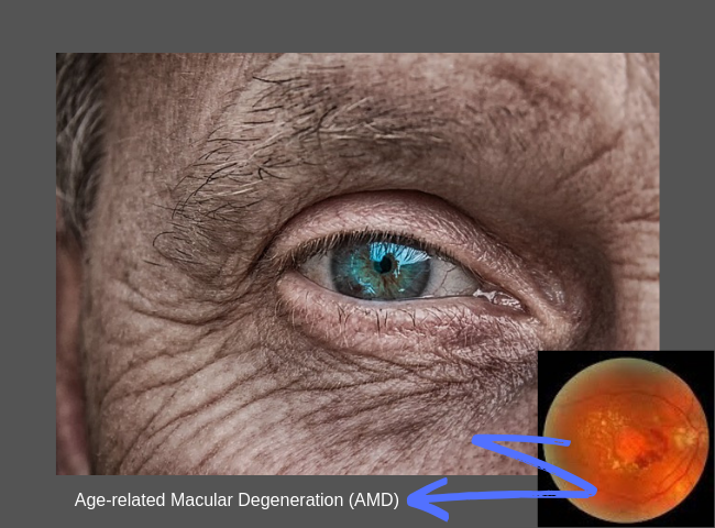 Age-related Macular Degeneration